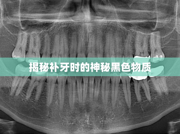 揭秘補牙時的神秘黑色物質(zhì)