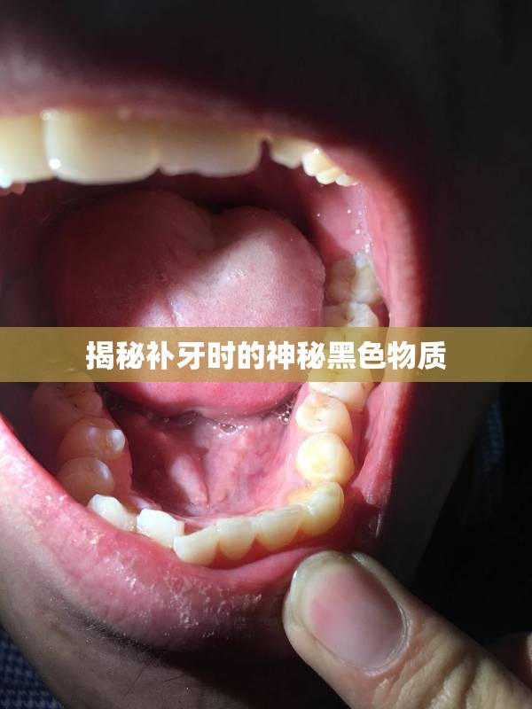 揭秘補牙時的神秘黑色物質(zhì)