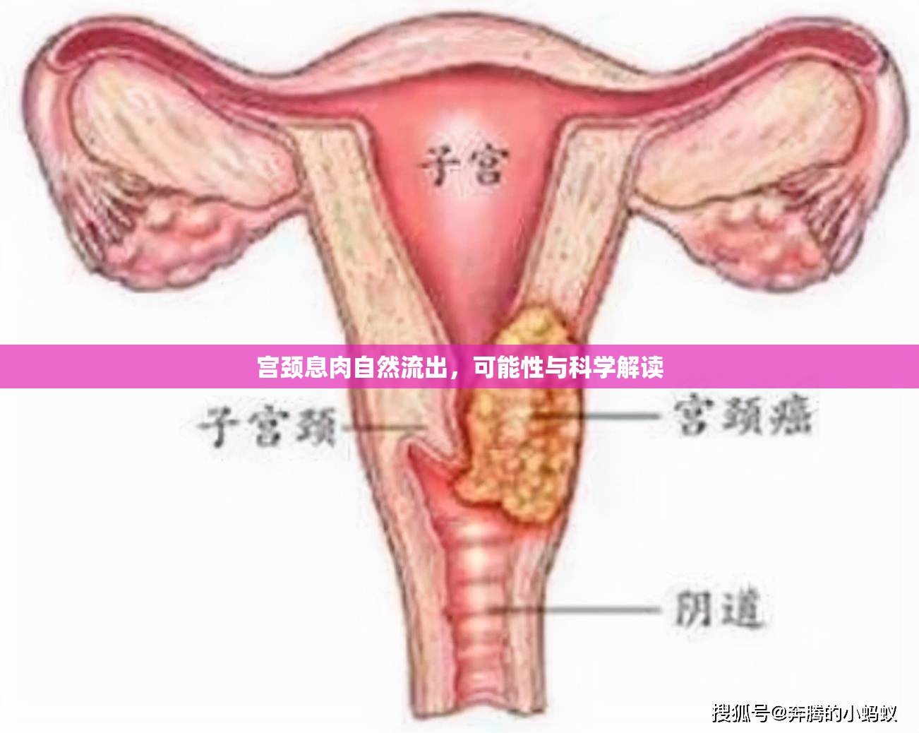 宮頸息肉自然流出，可能性與科學(xué)解讀