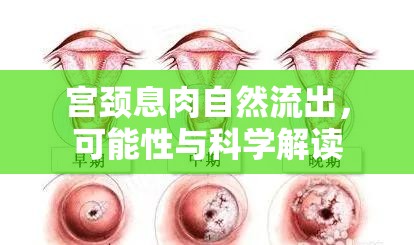 宮頸息肉自然流出，可能性與科學(xué)解讀