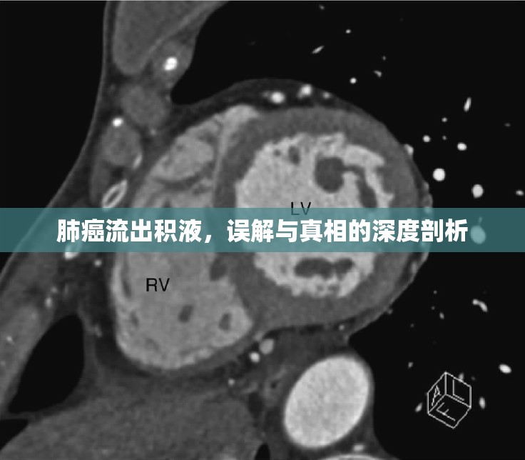 肺癌流出積液，誤解與真相的深度剖析