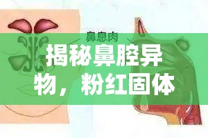 揭秘鼻腔異物，粉紅固體的真相與應(yīng)對(duì)策略
