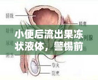 小便后流出果凍狀液體，警惕前列腺問題或性病癥狀