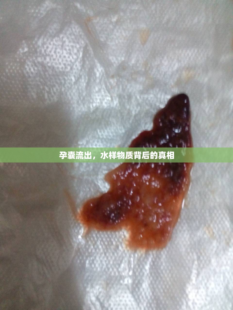 孕囊流出，水樣物質(zhì)背后的真相