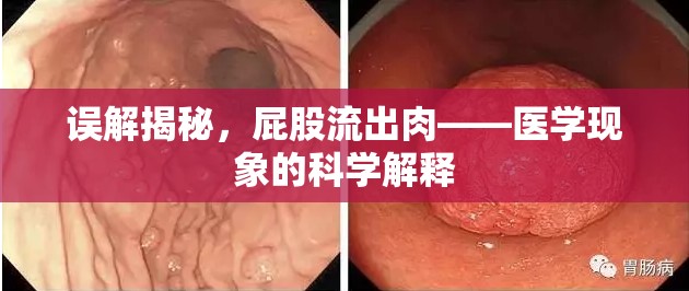 誤解揭秘，屁股流出肉——醫(yī)學(xué)現(xiàn)象的科學(xué)解釋