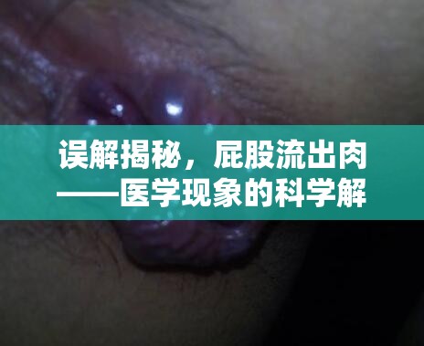 誤解揭秘，屁股流出肉——醫(yī)學(xué)現(xiàn)象的科學(xué)解釋