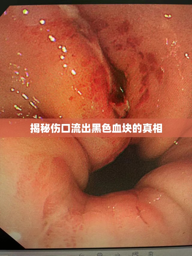 揭秘傷口流出黑色血塊的真相