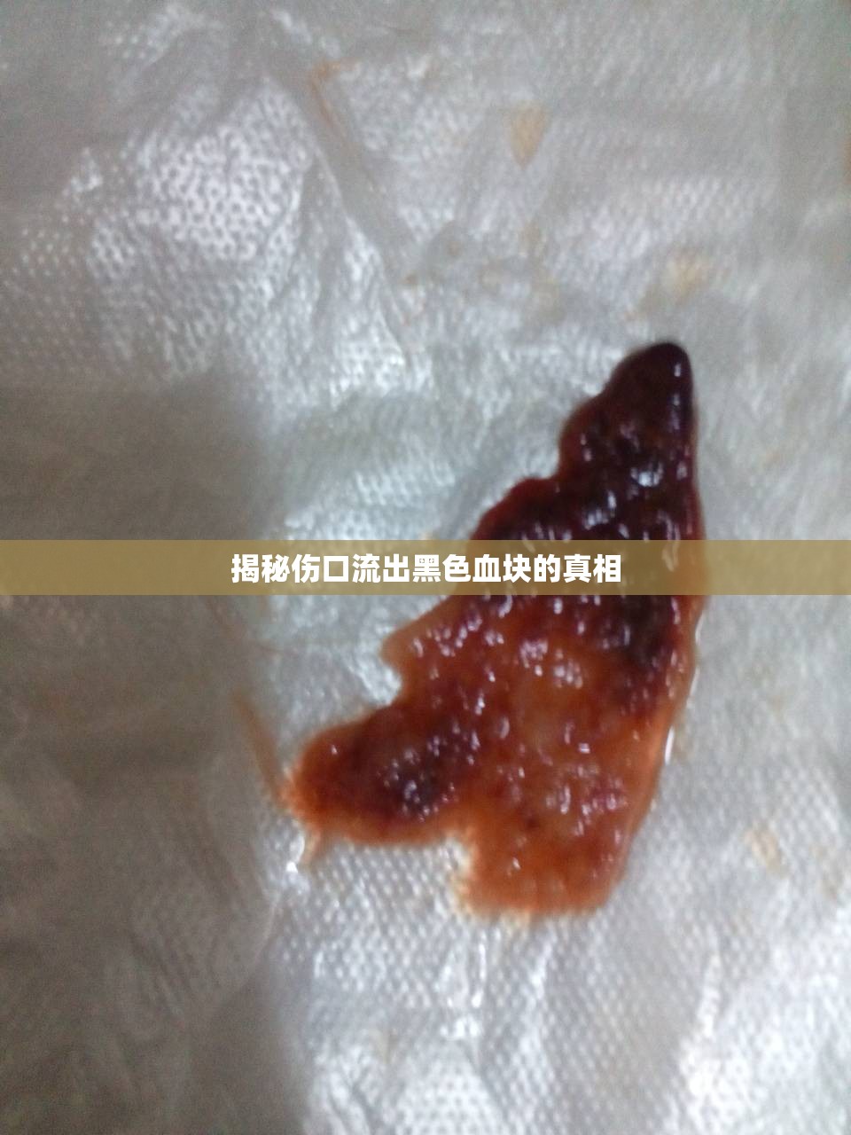 揭秘傷口流出黑色血塊的真相