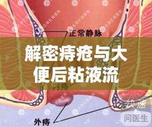 解密痔瘡與大便后粘液流出的關(guān)系，從癥狀識別到預(yù)防策略的全面指南