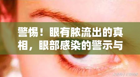 警惕！眼有膿流出的真相，眼部感染的警示與應(yīng)對(duì)策略