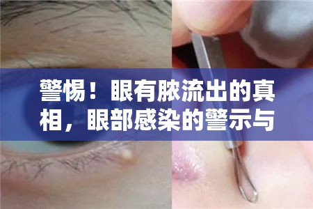警惕！眼有膿流出的真相，眼部感染的警示與應(yīng)對(duì)策略