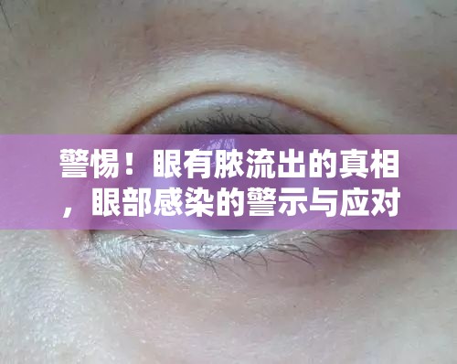 警惕！眼有膿流出的真相，眼部感染的警示與應(yīng)對(duì)策略