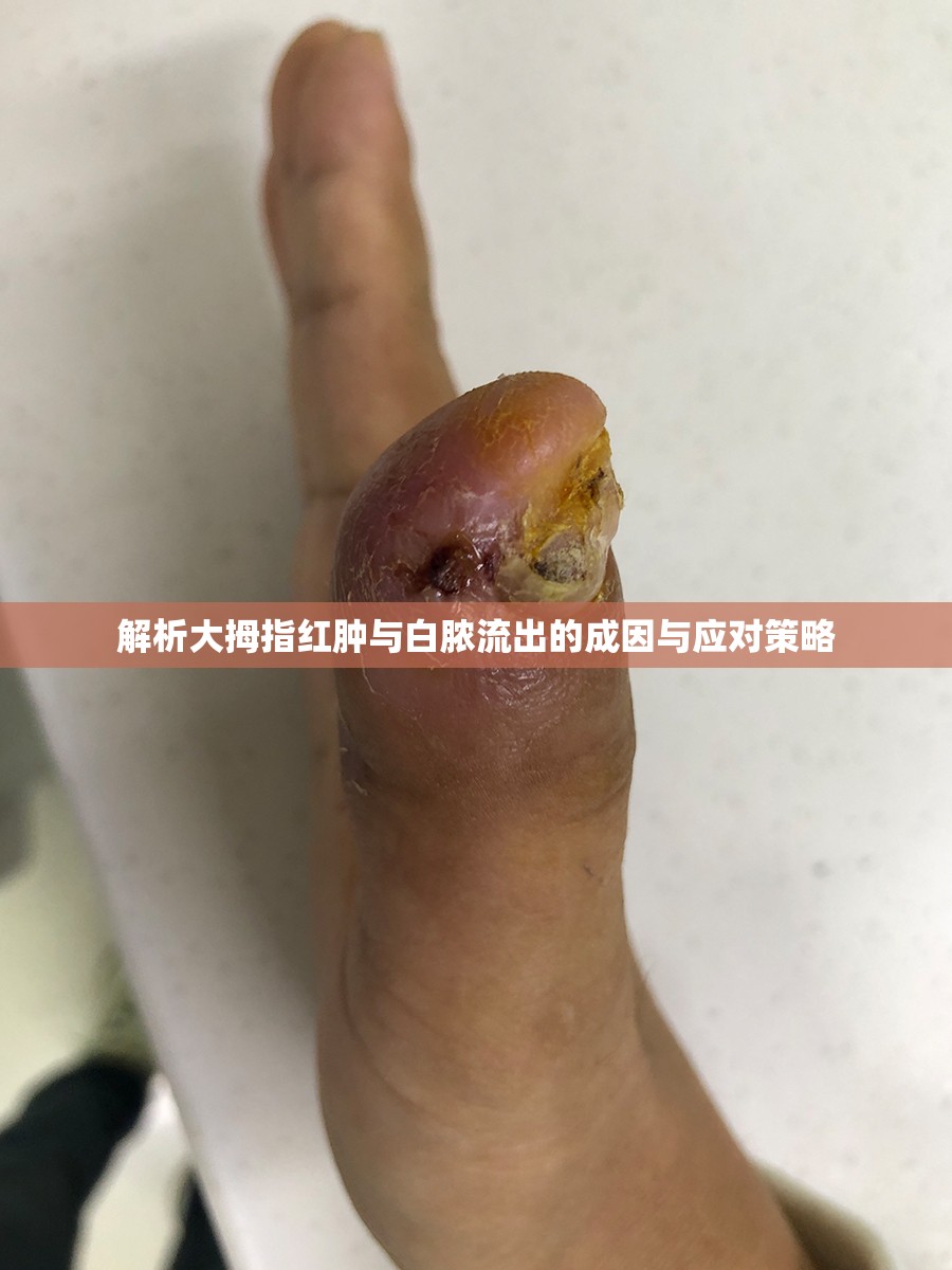 解析大拇指紅腫與白膿流出的成因與應(yīng)對(duì)策略