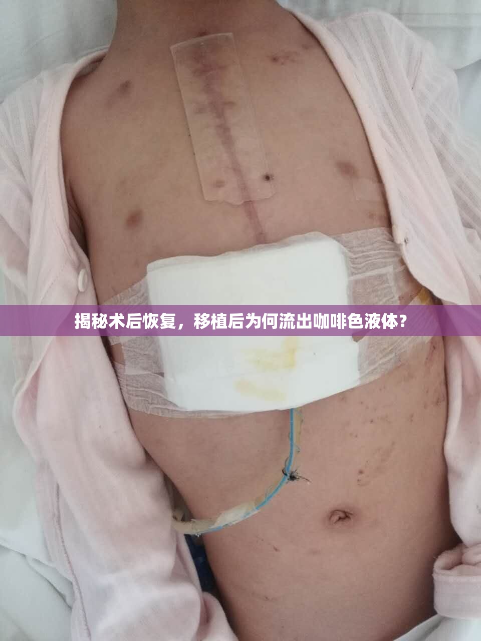 揭秘術(shù)后恢復(fù)，移植后為何流出咖啡色液體？