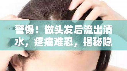 警惕！做頭發(fā)后流出清水，疼痛難忍，揭秘隱藏的頭皮健康危機(jī)