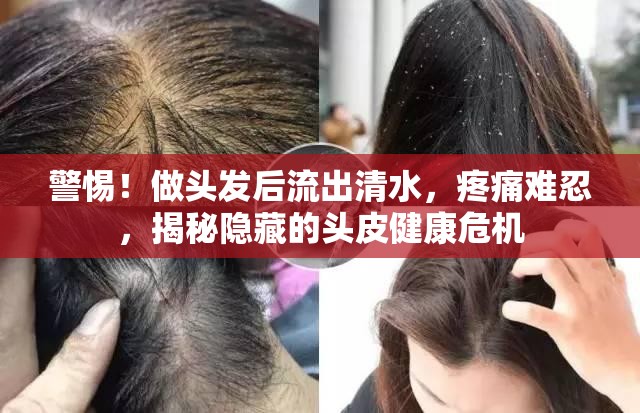 警惕！做頭發(fā)后流出清水，疼痛難忍，揭秘隱藏的頭皮健康危機(jī)