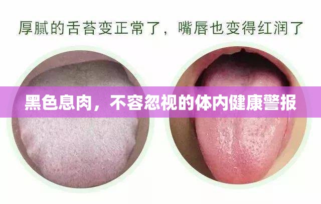 黑色息肉，不容忽視的體內(nèi)健康警報(bào)