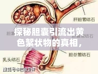 探秘膽囊引流出黃色絮狀物的真相，健康警報與科學解讀