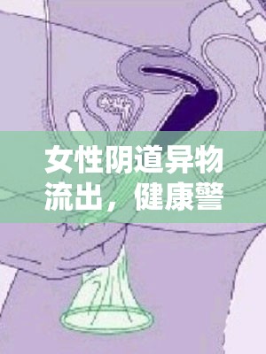 女性陰道異物流出，健康警報與應(yīng)對策略
