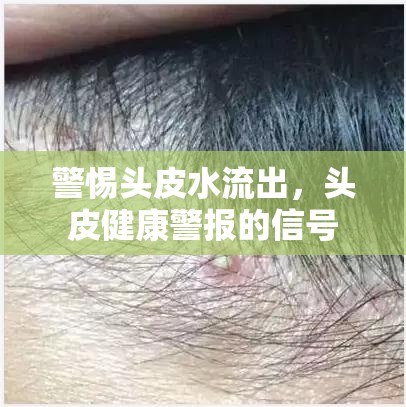 警惕頭皮水流出，頭皮健康警報的信號