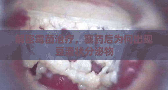 解密霉菌治療，塞藥后為何出現(xiàn)豆渣狀分泌物