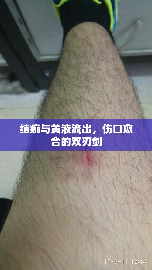 結(jié)痂與黃液流出，傷口愈合的雙刃劍