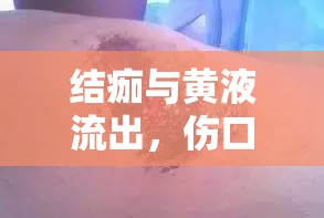 結(jié)痂與黃液流出，傷口愈合的雙刃劍