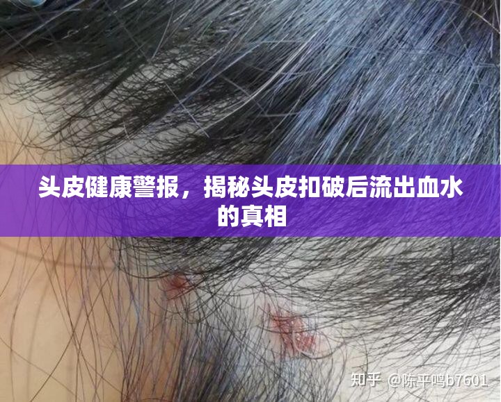頭皮健康警報，揭秘頭皮扣破后流出血水的真相