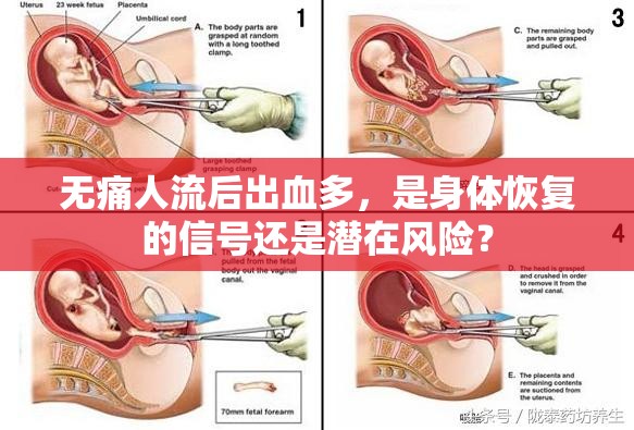 無痛人流后出血多，是身體恢復(fù)的信號(hào)還是潛在風(fēng)險(xiǎn)？