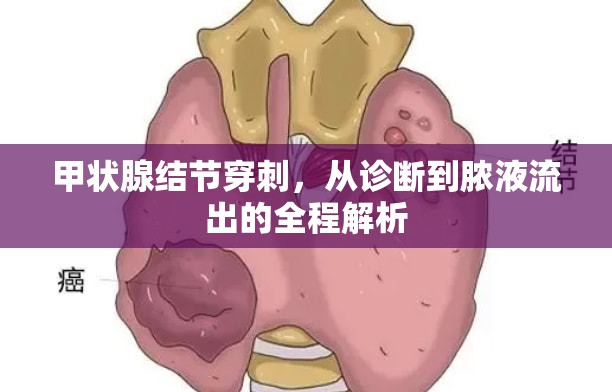 甲狀腺結(jié)節(jié)穿刺，從診斷到膿液流出的全程解析