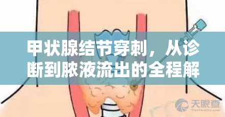 甲狀腺結(jié)節(jié)穿刺，從診斷到膿液流出的全程解析