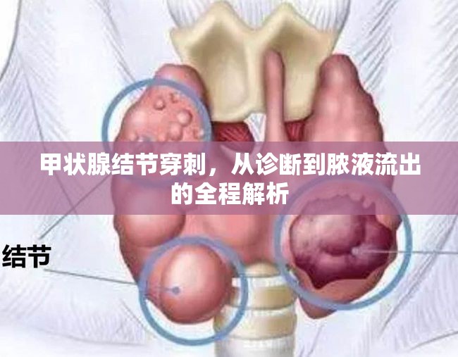 甲狀腺結(jié)節(jié)穿刺，從診斷到膿液流出的全程解析