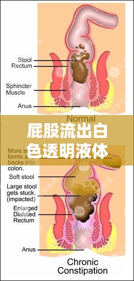 屁股流出白色透明液體的真相，健康、醫(yī)學(xué)與誤解的交織