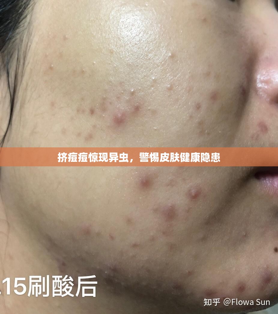 擠痘痘驚現(xiàn)異蟲(chóng)，警惕皮膚健康隱患