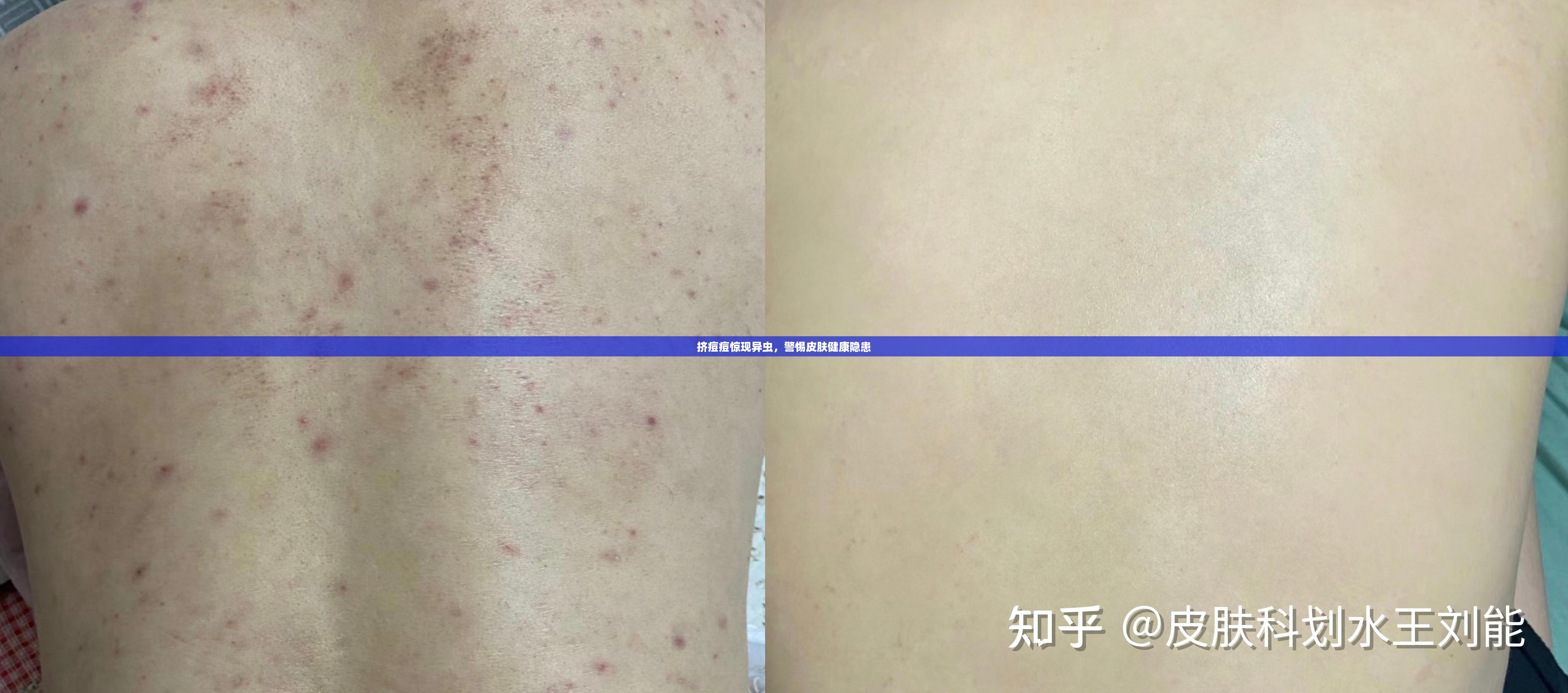 擠痘痘驚現(xiàn)異蟲(chóng)，警惕皮膚健康隱患