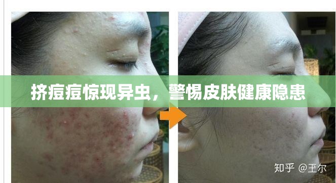 擠痘痘驚現(xiàn)異蟲(chóng)，警惕皮膚健康隱患