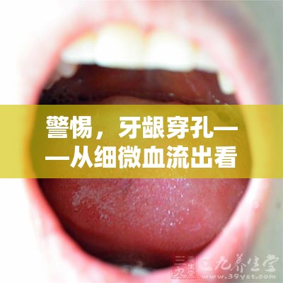 警惕，牙齦穿孔——從細(xì)微血流出看口腔健康的警鐘