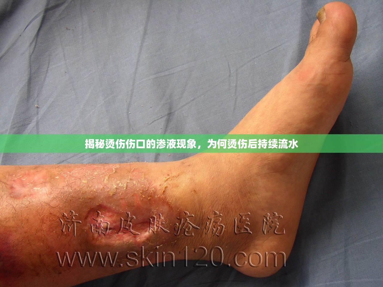 揭秘燙傷傷口的滲液現(xiàn)象，為何燙傷后持續(xù)流水