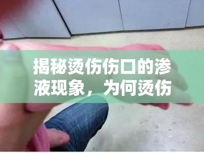揭秘燙傷傷口的滲液現(xiàn)象，為何燙傷后持續(xù)流水