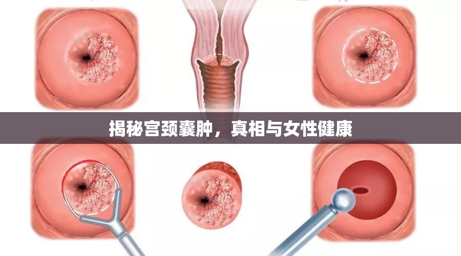 揭秘宮頸囊腫，真相與女性健康