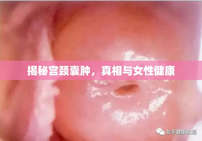 揭秘宮頸囊腫，真相與女性健康