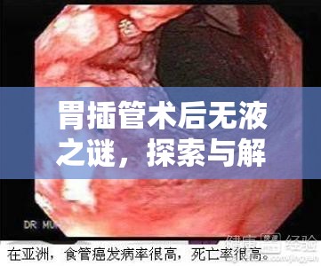 胃插管術后無液之謎，探索與解析