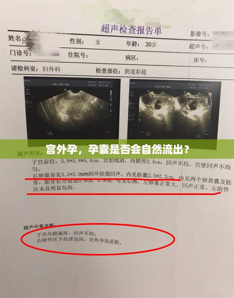 宮外孕，孕囊是否會(huì)自然流出？