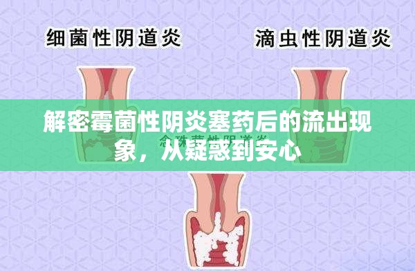 解密霉菌性陰炎塞藥后的流出現(xiàn)象，從疑惑到安心