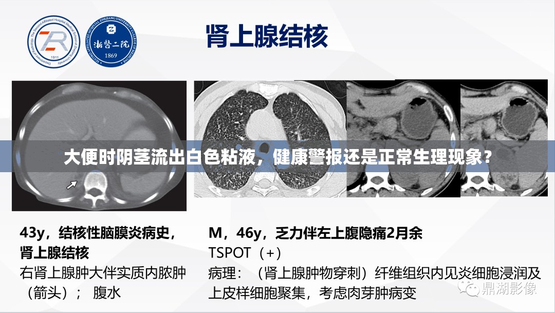大便時陰莖流出白色粘液，健康警報還是正常生理現(xiàn)象？