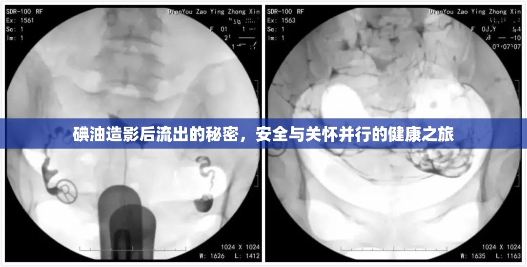 碘油造影后流出的秘密，安全與關懷并行的健康之旅