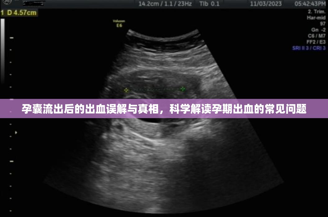 孕囊流出后的出血誤解與真相，科學解讀孕期出血的常見問題