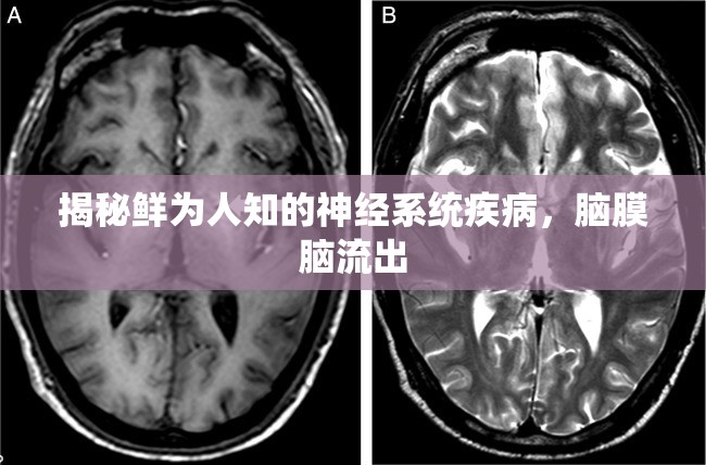 揭秘鮮為人知的神經(jīng)系統(tǒng)疾病，腦膜腦流出