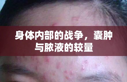 身體內(nèi)部的戰(zhàn)爭，囊腫與膿液的較量