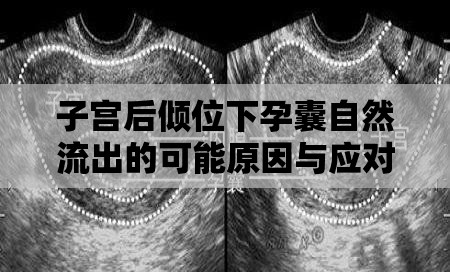 子宮后傾位下孕囊自然流出的可能原因與應(yīng)對(duì)措施